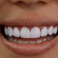 خدمات دندانپزشکی(روکش و کامپوزیت‌و..)|خدمات آرایشگری و زیبایی|گرگان, |دیوار