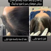 مزوتراپی و مزونیدلینگ مو درمان ریزش مو و رویش مجدد