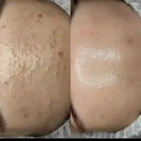 برداشتن خال زگیل‌ کک مک و فشیال