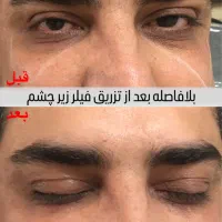 تزریق بوتاکس و فیلر|خدمات آرایشگری و زیبایی|رشت, خواهر امام|دیوار