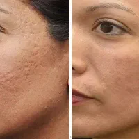 لیزر جای زخم و لک و جوانسازی