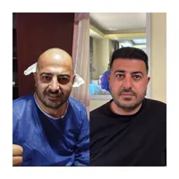 کاشت مو  ابرو  ریش به روش شیرازی|خدمات آرایشگری و زیبایی|سنندج, |دیوار