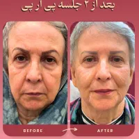 جوانسازی پوست وکمک به تقویت موها با روش پی آر پی