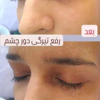 آموزش فیشال و پاکسازی تخصصی پوست مزونیدلینگ مزوایت|خدمات آرایشگری و زیبایی|مشهد, احمدآباد|دیوار