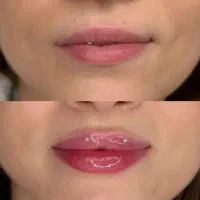 ژل وبوتاکس آنزیم مزو صورت و مو مزونیدلینگ