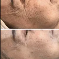 تزریق ژل و بوتاکس جشنواره|خدمات زیبایی و سلامت|تهران, عبدلآباد|دیوار