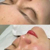 فشیال و خدمات درمانی پوست و لیزر خال و زگیل