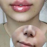 بلفارو ژل بوتاکس غبغب آنزیم|خدمات آرایشگری و زیبایی|اهواز, نادری|دیوار