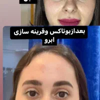 آف هفتگی تزریق ژل و بوتاکس و مزوژل جوانساز|خدمات آرایشگری و زیبایی|آمل, |دیوار