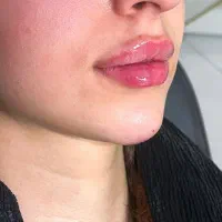 فیلر ،بوتاکس ، مزو ، مزوژل مدل|خدمات آرایشگری و زیبایی|اصفهان, سعادت‌آباد|دیوار