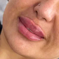 فیلر،بوتاکس،لیزر،فیشال،مزوتراپی