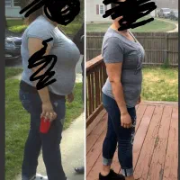 بوتاکس معده و لاغری تضمینی توسط فقط متخصص گوارش