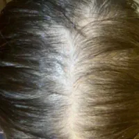 با ریزش مو و کمپشتی مو خدافظی کن