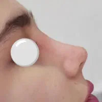 عمل زیبایی بینی