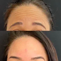 هایفوتراپی در مطب پزشک با قیمتی باورنکردنی|خدمات آرایشگری و زیبایی|مشهد, چهارچشمه|دیوار