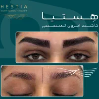 کاشت ابرو تخصصی هستیا