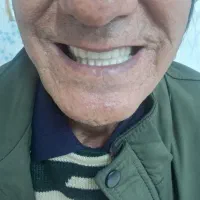 دندان سازی ۲۰ درصد تخفیف