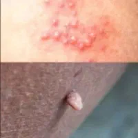 بهبود سریع ز.گیل تنا.سلی و تبخال تنا.سلی