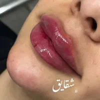 خدمات ژل وبوتاکس