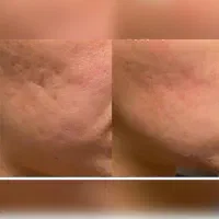 مزوژل جوانساز پوستتو جوان کن prp۹۸۰|خدمات زیبایی و سلامت|اصفهان, بهار آزادی|دیوار