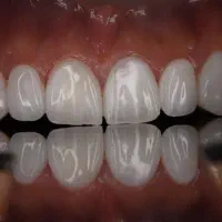 دندانسازی دندانپزشکی کامپوزیت فکی 10درمطب ارتودنسی