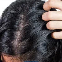 درمان بدون درد سر شوره مو|آرایشی، بهداشتی، درمانی|شادگان, |دیوار