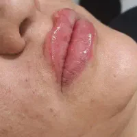 جشنواره ژل و بوتاکس و مزوتراپی لک وجوانسازی بانوان|خدمات آرایشگری و زیبایی|اصفهان, عسگریه|دیوار