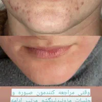 فیشال و مزونیدلینگ پوست و لیفت مژه ابرو و کاشت مژه|خدمات آرایشگری و زیبایی|تهران, تهرانپارس غربی|دیوار