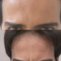 خدمات تخصصی تزریق بوتاکس فیلر بانوان و آقایون|خدمات آرایشگری و زیبایی|بیرجند, |دیوار