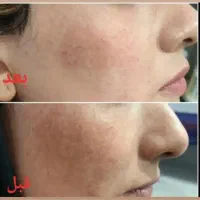 ژل بوتاکس پی آرپی لیفت مزوتراپی توسط پزشک در مطب|خدمات آرایشگری و زیبایی|اسلام‌شهر, باغ فیض|دیوار