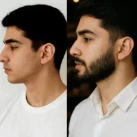 رویش ریش وسبیل کمتراز ۳۰روز