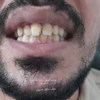 کامپوزیت زیبایی دندان، لمینت، روکش  زیرکونیا|خدمات آرایشگری و زیبایی|کرمانشاه, |دیوار