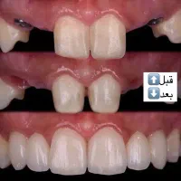 شرایط اقساطی دندانپزشکی و ایمپلنت