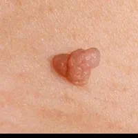 زگیل تناسلیhpv/میخچه/زیگیل/خال/اسکین تگ خالبرداری|خدمات آرایشگری و زیبایی|تهران, علم و صنعت|دیوار