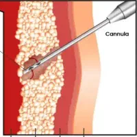 ساکشن شکم پهلو