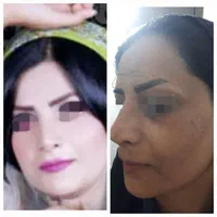 لیزر co2تک جلسه ای،تزریق چربی ودیگر خدمات زیبایی|خدمات آرایشگری و زیبایی|یاسوج, |دیوار