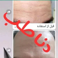 کرم بوتاکس گیاهی تضمینی