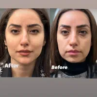 تخفیفات استثنایی ژل و بوتاکس در مطب زیبایی|خدمات آرایشگری و زیبایی|قم, دورشهر|دیوار