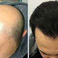 کاشت مو تخصصی اولین بار در اردبیل