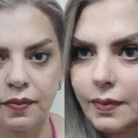 آف ویژه تخلیه وتزریق چربی