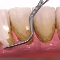 جرم گیری و بروساژ .روکش.پر کردن