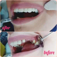 ،روکش سرامیکی، ترمیم، فوری،دندانپزشکی