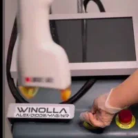 لیزرموهای زائد در فولادشهر