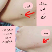 حذف خال زگیل  و میخچه