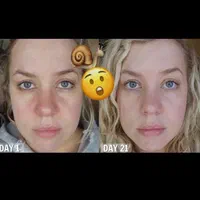 فروش حلزون آلبینو مخصوص حلزون‌تراپی