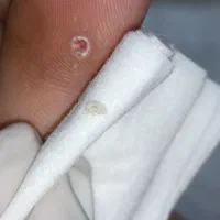 دذمان میخچه و ناخن در گوشت