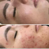 درمان تضمینی و دائم تو رفتگی/جای جوش/اسکار/اگزوزوم