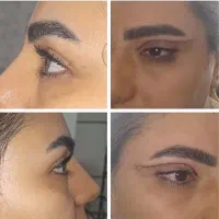 بلفارو پلک بالا و پایین/عمل پلک