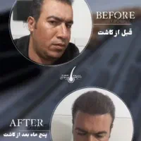 کاشت مو و کاشت اَبرو