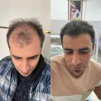 کاشت مو تبریز|خدمات آرایشگری و زیبایی|میانه, |دیوار